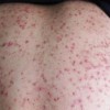 毛囊炎患者如何日常护理呢
