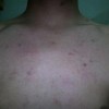 头部毛囊炎要怎么护理
