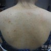 患了毛囊炎生活护理怎么做
