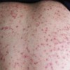 毛囊炎护理方面有哪些需要注意