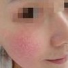 红血丝患者如何保养呢