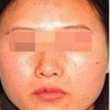 红血丝的护理是怎样的