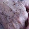 老年斑增多小心疾病的产生