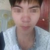 女生易得酒糟鼻的原因