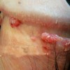 尖锐湿疣患者要注意哪些内容