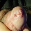 女性尖锐湿疣如何护理