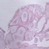 尖锐湿疣患者应该要如何护理