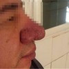 日常生活中如何预防酒糟鼻