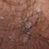 女性尖锐湿疣会发生哪些危害