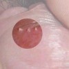 睡眠不足对尖锐湿疣有什么影响