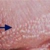 尖锐湿疣有哪些主要的传染途径