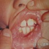 尖锐湿疣疾病在患者身上体现的异状
