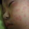 治疗荨麻疹的常见方法