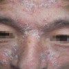 在冬季儿童牛皮癣怎样护理