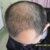 雄性激素与脂溢性脱发的关系