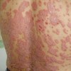 春夏交际牛皮癣病人注意了