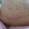 治疗疥疮要求有哪些要注意问题