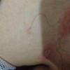 得了疥疮怎样合理护理