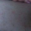 疥疮治疗应该有哪些要注意