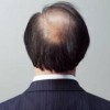 防脱发如何用洗发水