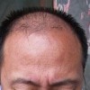 哪些措施可以预防脱发