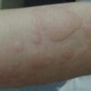 有关于荨麻疹检查方法