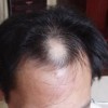 脱发的预防措施都有哪些