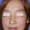 雀斑特别注意