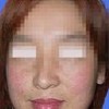 那么长雀斑的注意什么事情呢