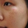 青少年雀斑患者要求注意哪些
