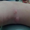 疥疮治愈后还会复发吗