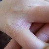 疥疮的预防小要点