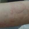 荨麻疹患者不能吃的