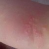 单纯疱疹症状的发生情况介绍