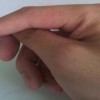 儿童单纯疱疹症状的表现