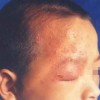 口角疱疹的症状主要是什么
