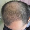 脱发最好的治疗的手法是什么