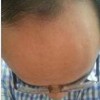 男人脱发怎么办