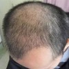治疗脱发的好方法是什么呢