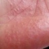 单纯疱疹病症判定的依据介绍