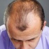 脂溢性脱发是由哪些原因导致的