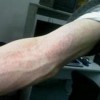 被蚊虫叮咬之后过敏