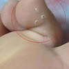 治疗脚气也要分清楚类型