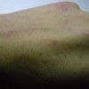 冬季减轻腿部瘙痒的方法