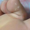 脚气病用什么药可以完全治愈呢