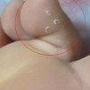 脚气治疗的最好方法是什么