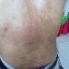 什么是肛门瘙痒