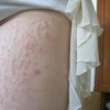 肛门瘙痒病的临床表现