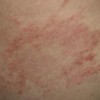 传染性脓疱病患者多自我感觉瘙痒