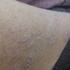 探索瘙痒症的发病原因